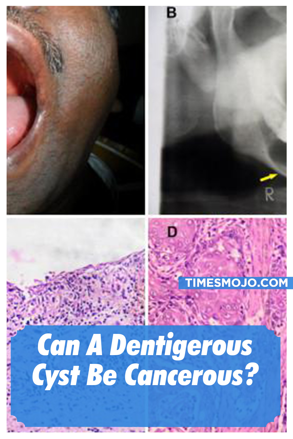 Can A Dentigerous Cyst Be Cancerous