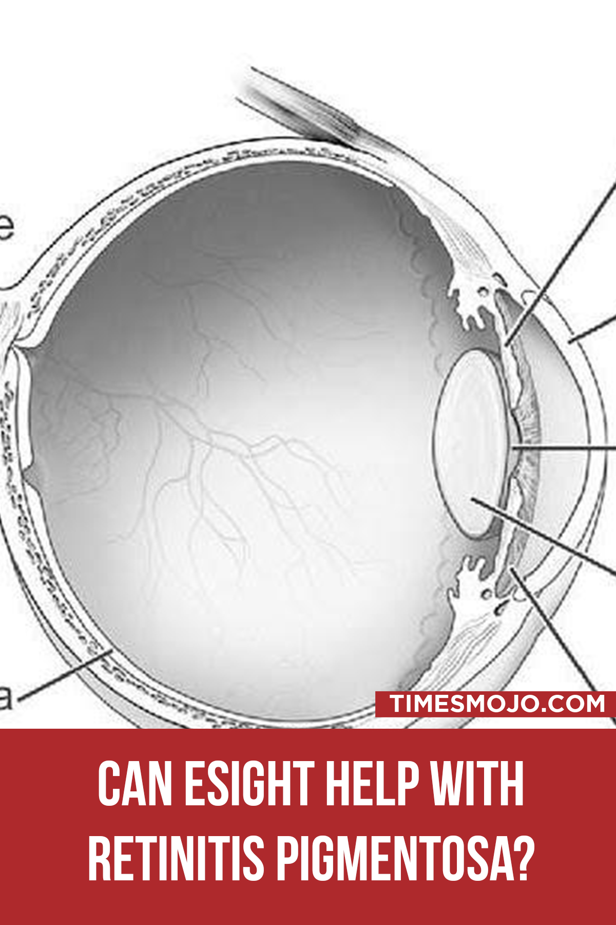 Can ESight Help With Retinitis Pigmentosa