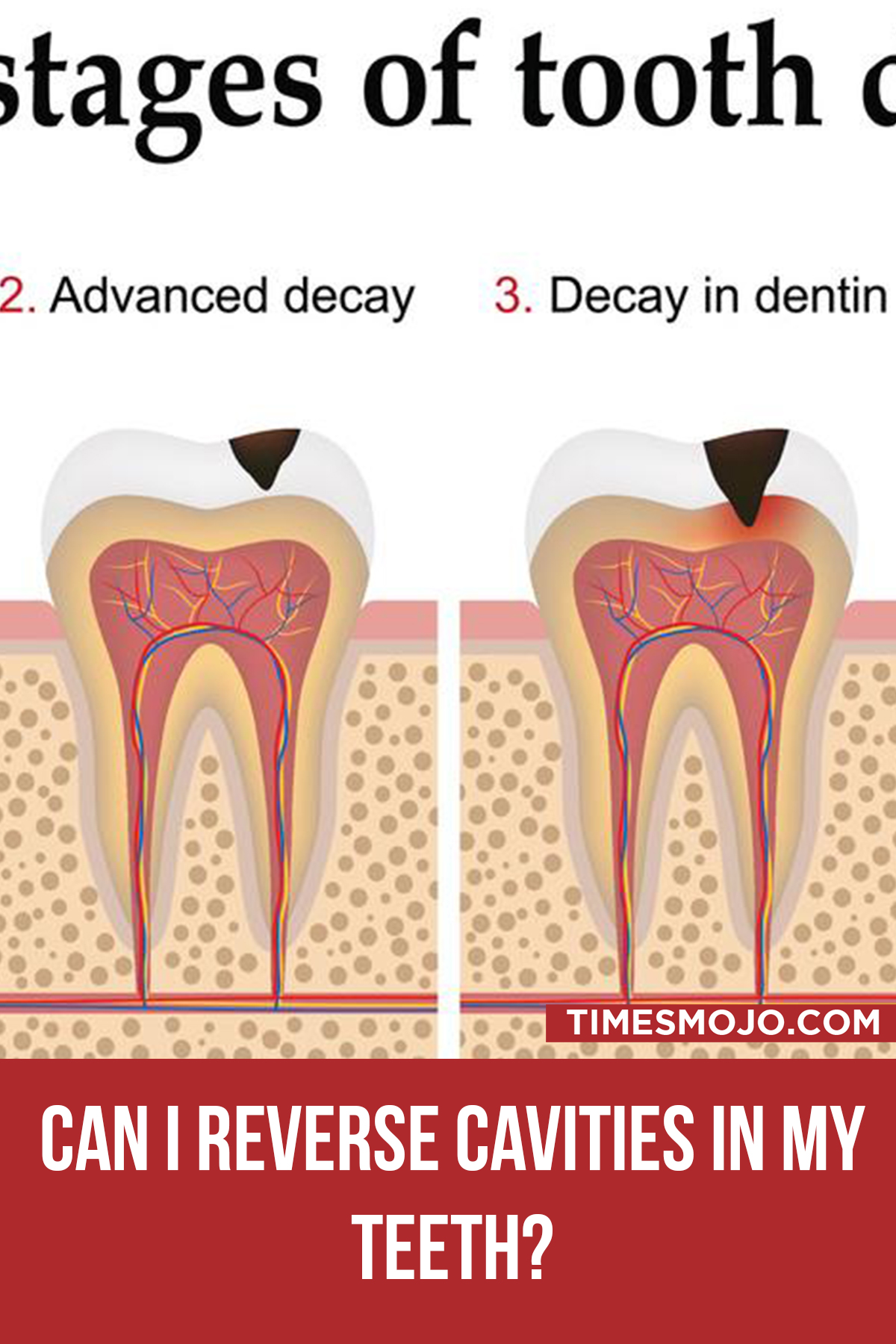 Can I Reverse Cavities In My Teeth