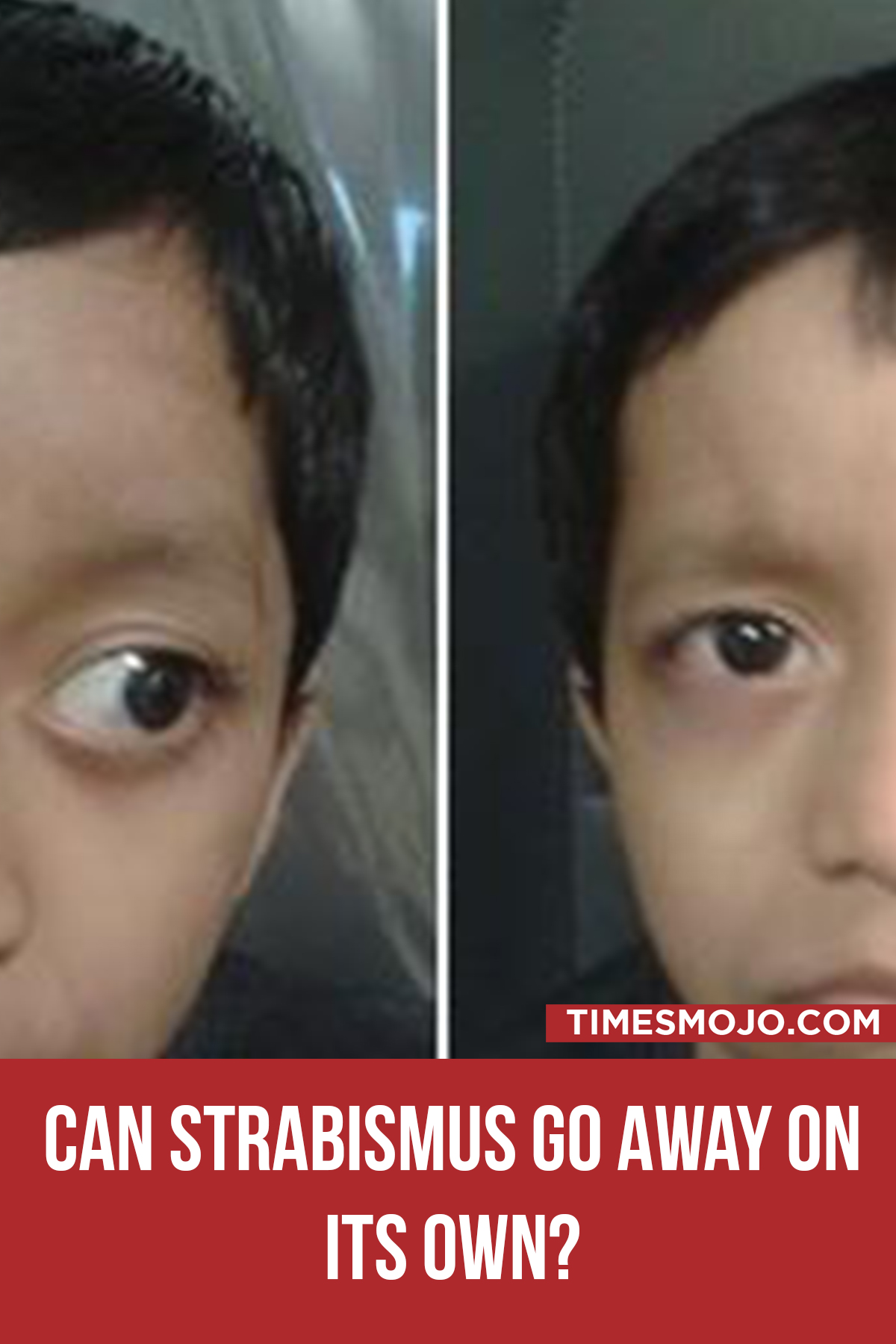 Can Strabismus Go Away On Its Own