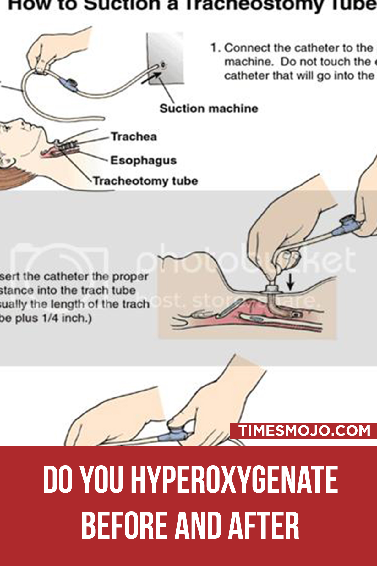 Do You Hyperoxygenate Before And After Suctioning