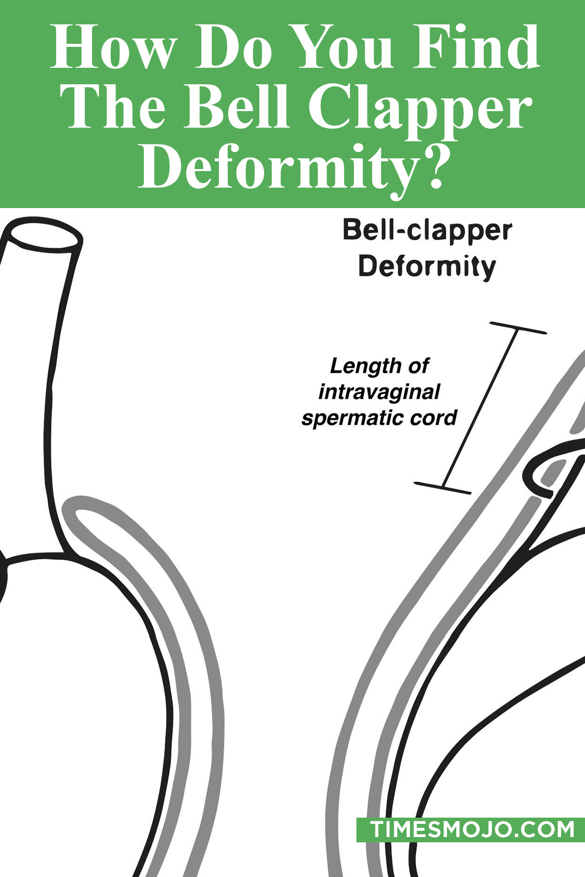 How Do You Find The Bell Clapper Deformity