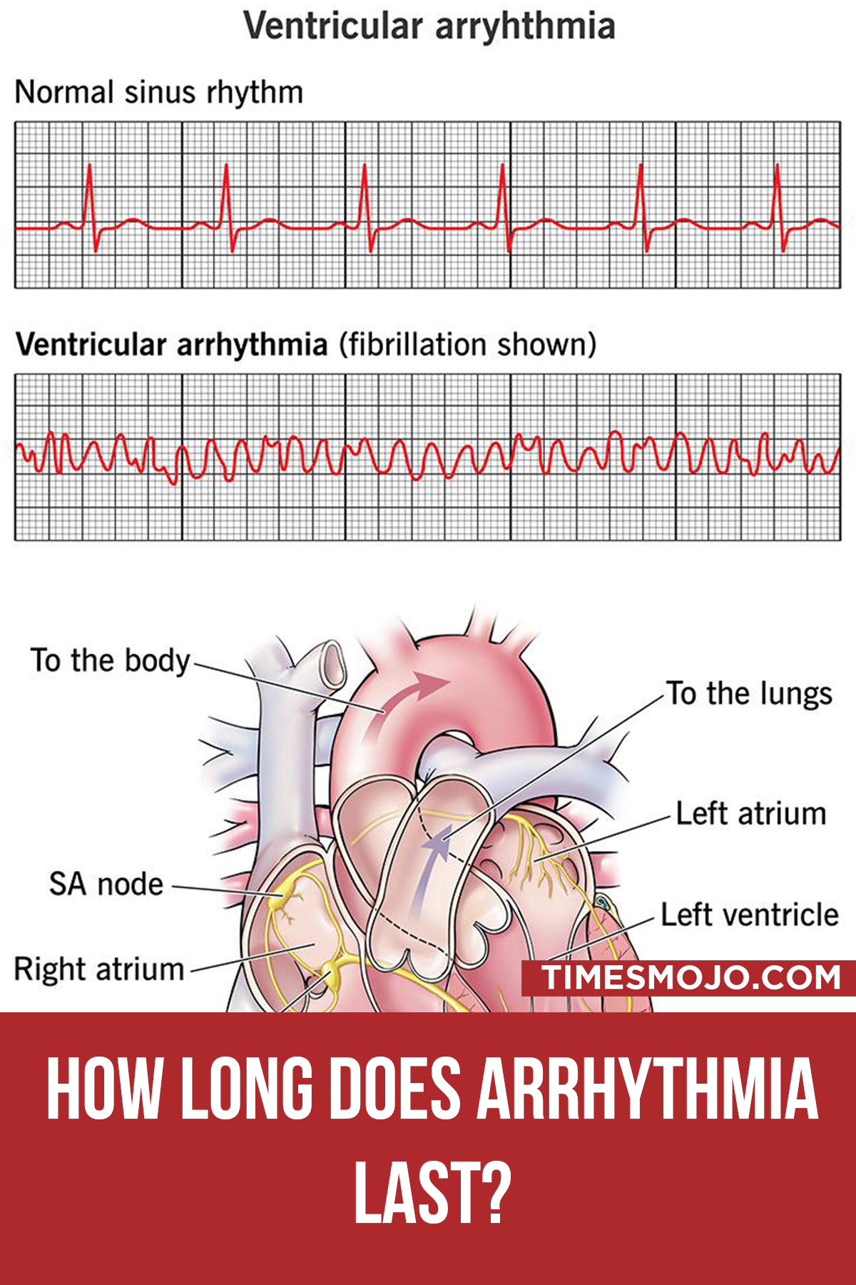 How Long Does Arrhythmia Last