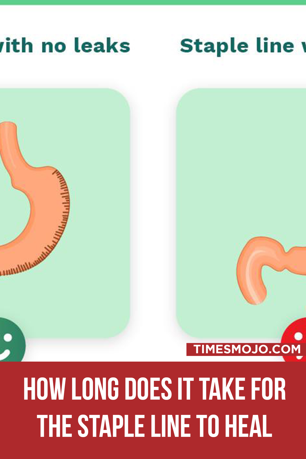 How Long Does It Take For The Staple Line To Heal After Gastric Sleeve