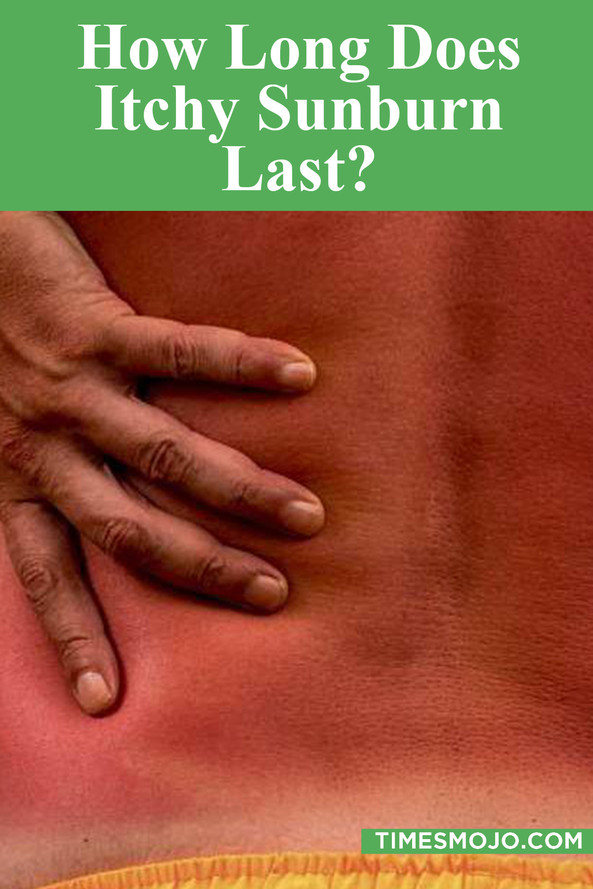 how-long-does-itchy-sunburn-last-timesmojo