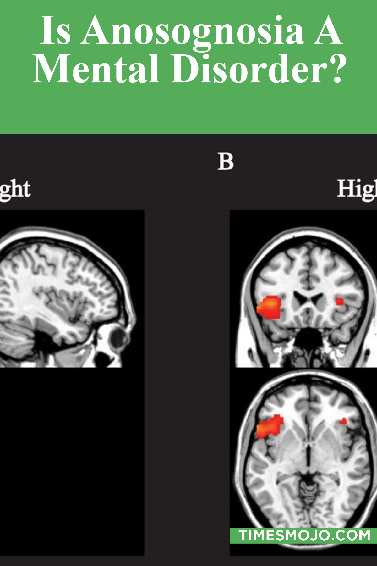 Is Anosognosia A Mental Disorder