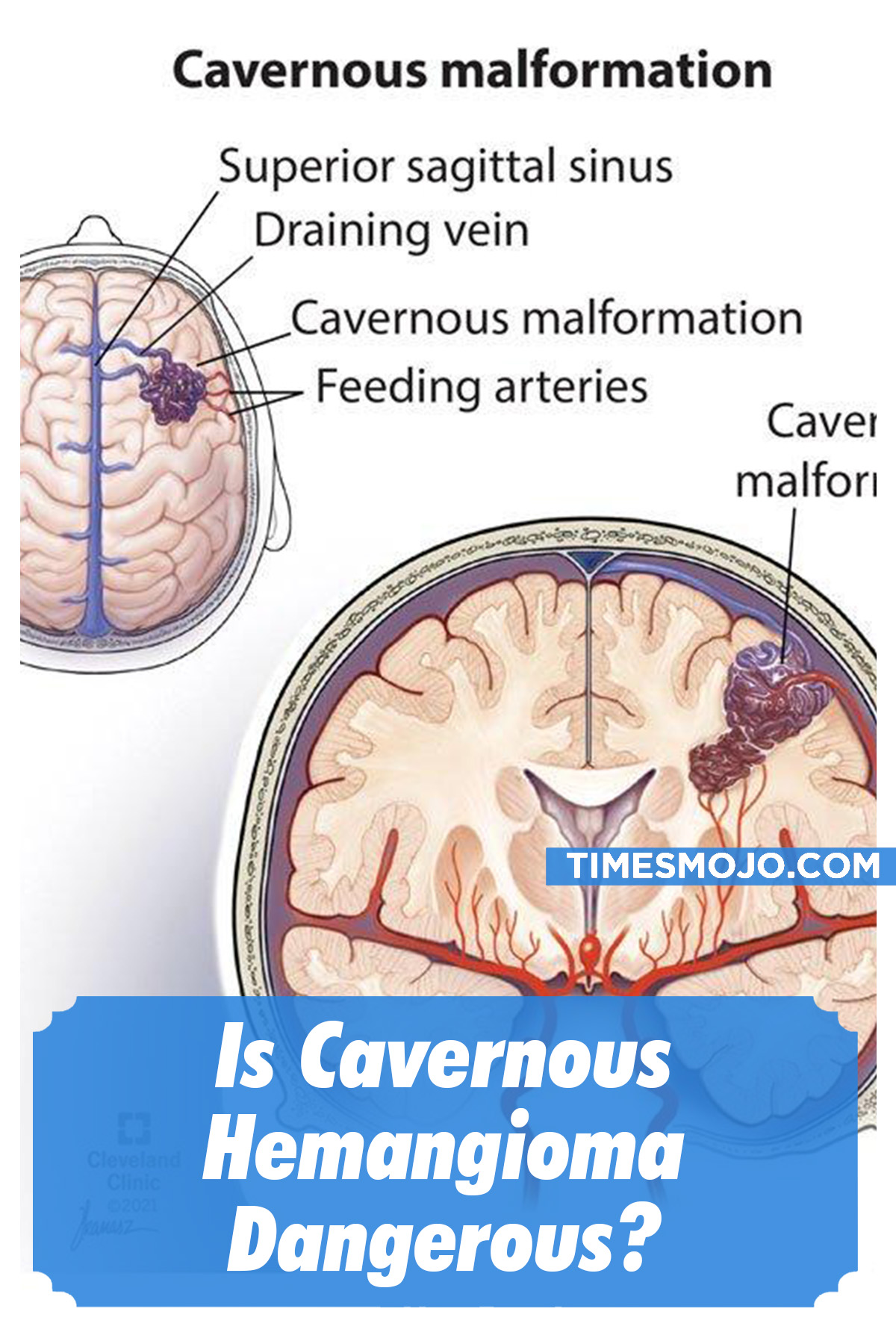 Is Cavernous Hemangioma Dangerous