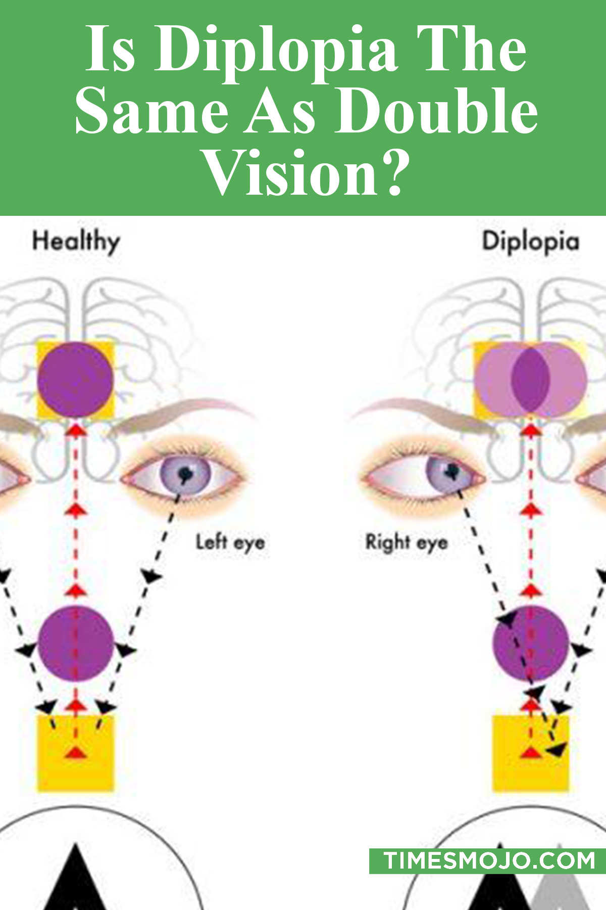 Is Diplopia The Same As Double Vision