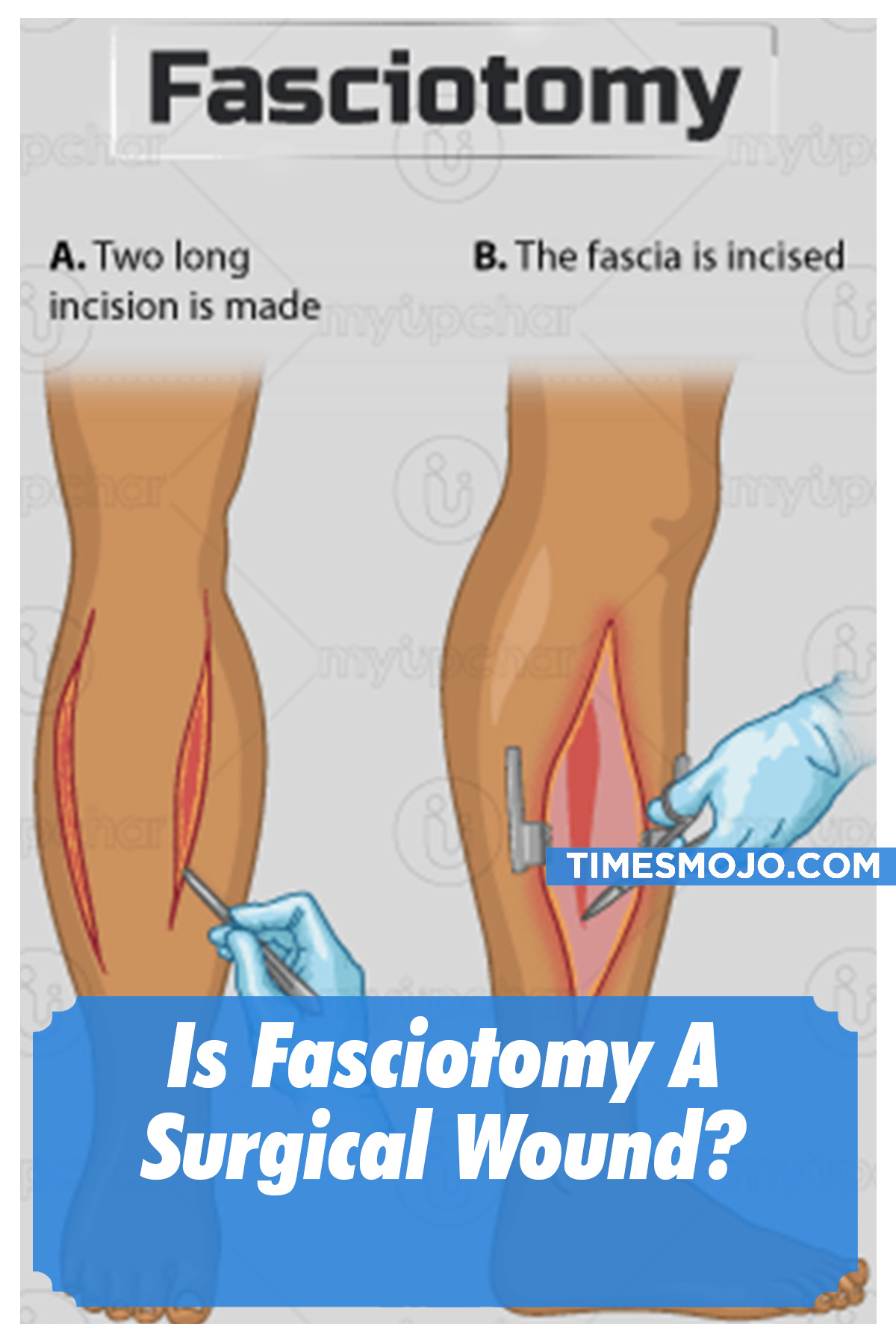 Is Fasciotomy A Surgical Wound