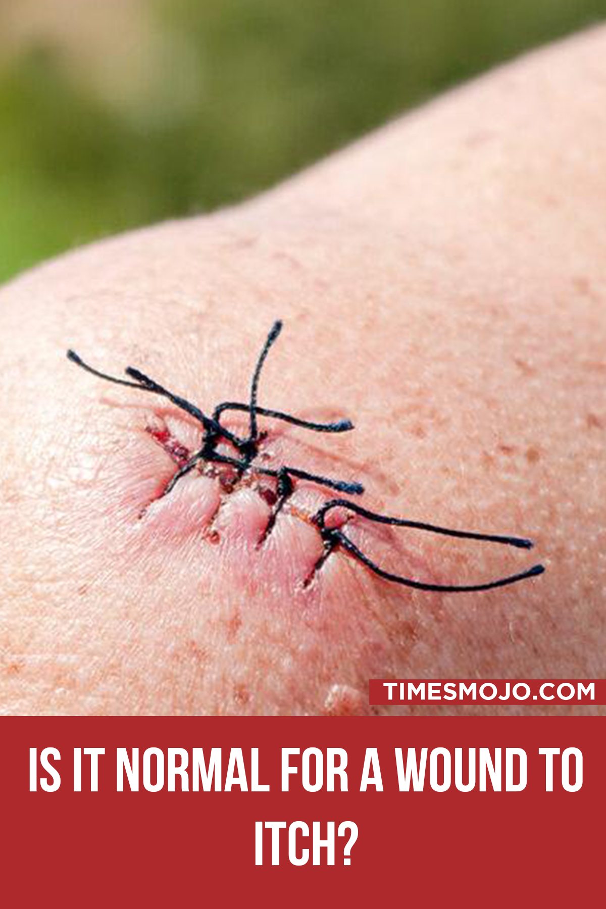 is-it-normal-for-a-wound-to-itch-timesmojo