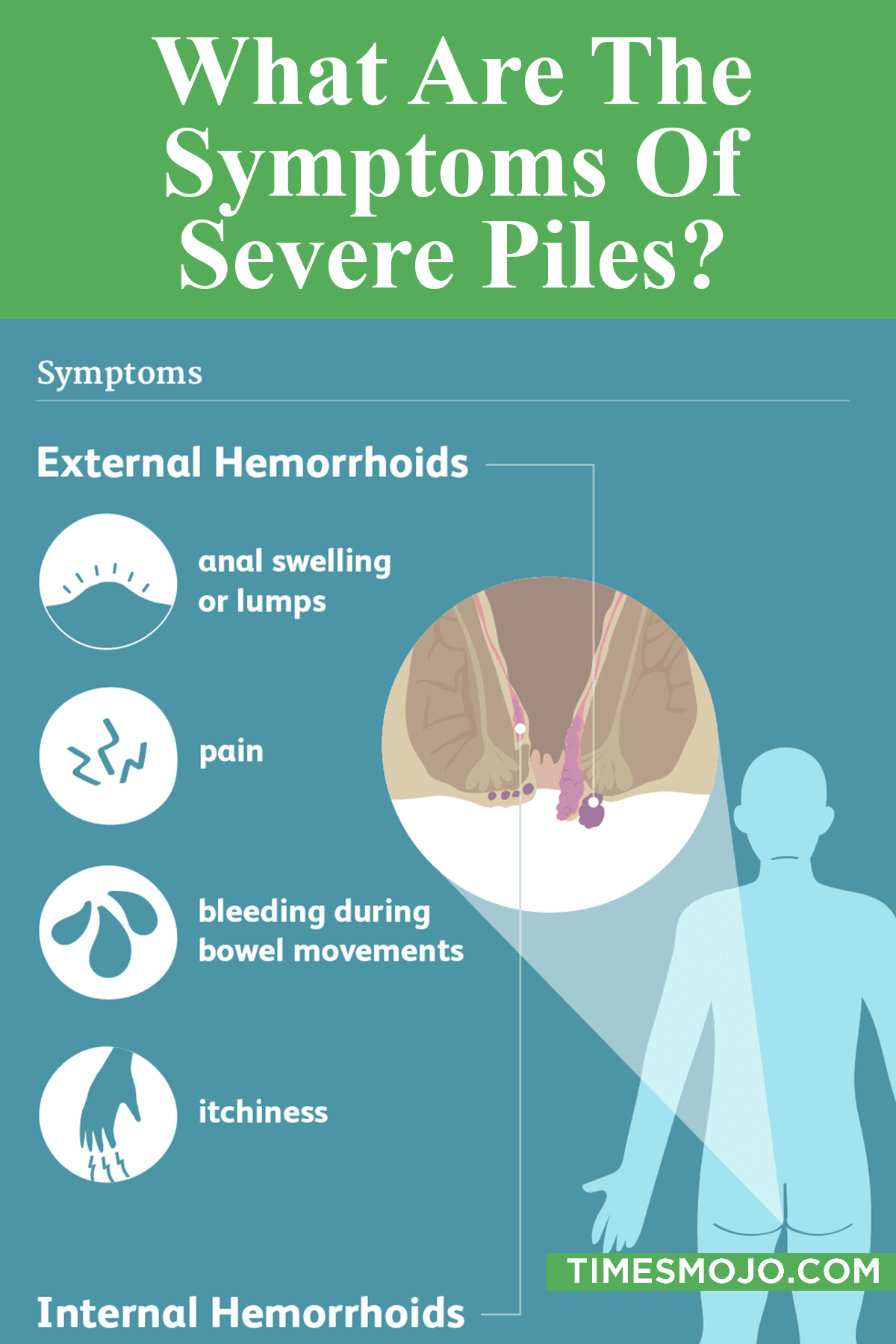 What Are The Symptoms Of Severe Piles