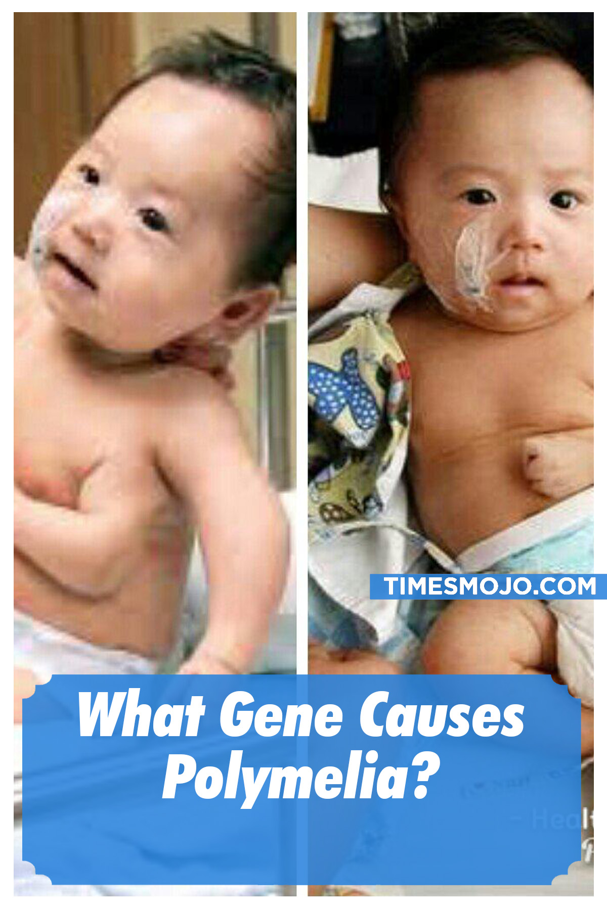 What Gene Causes Polymelia