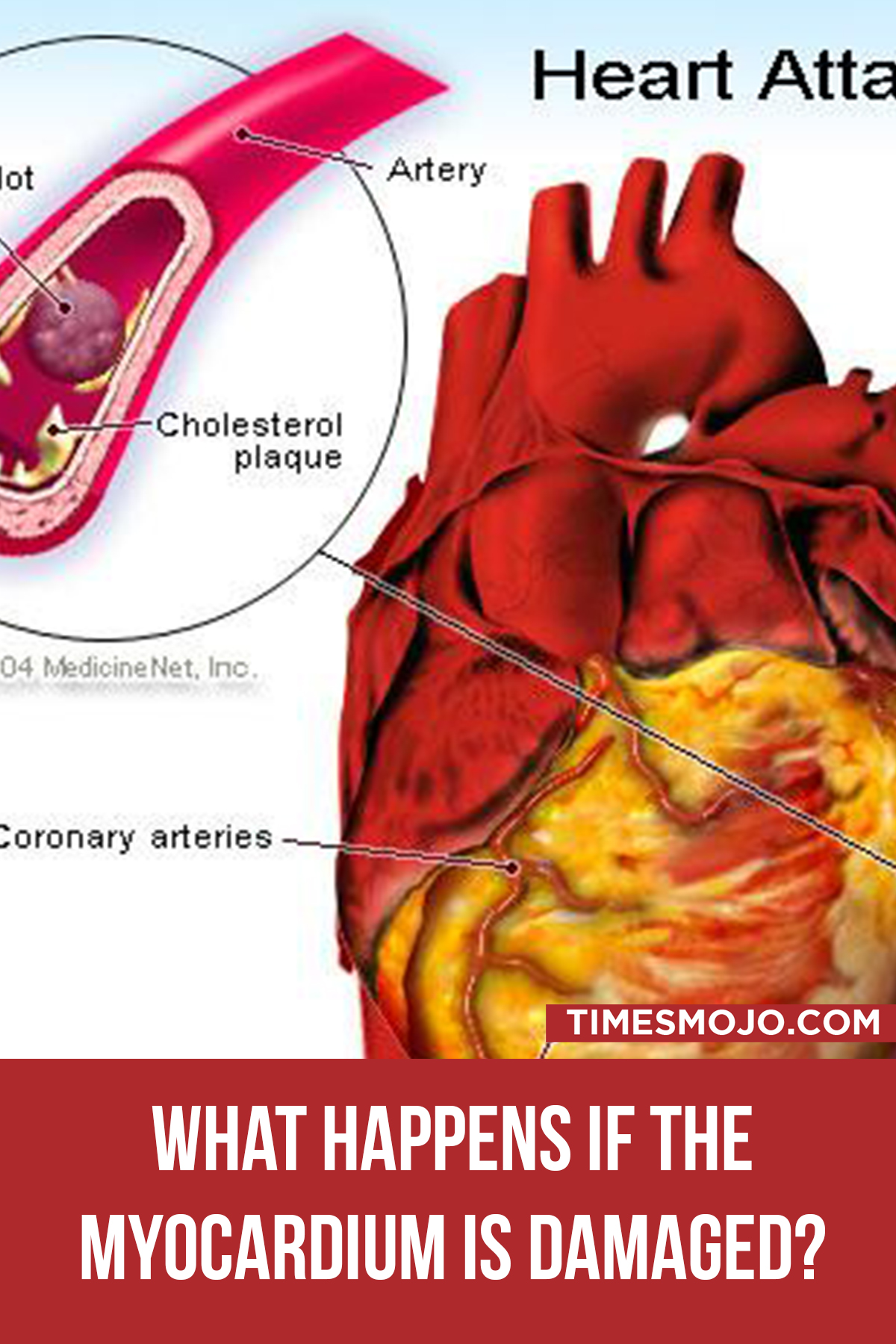 What Happens If The Myocardium Is Damaged