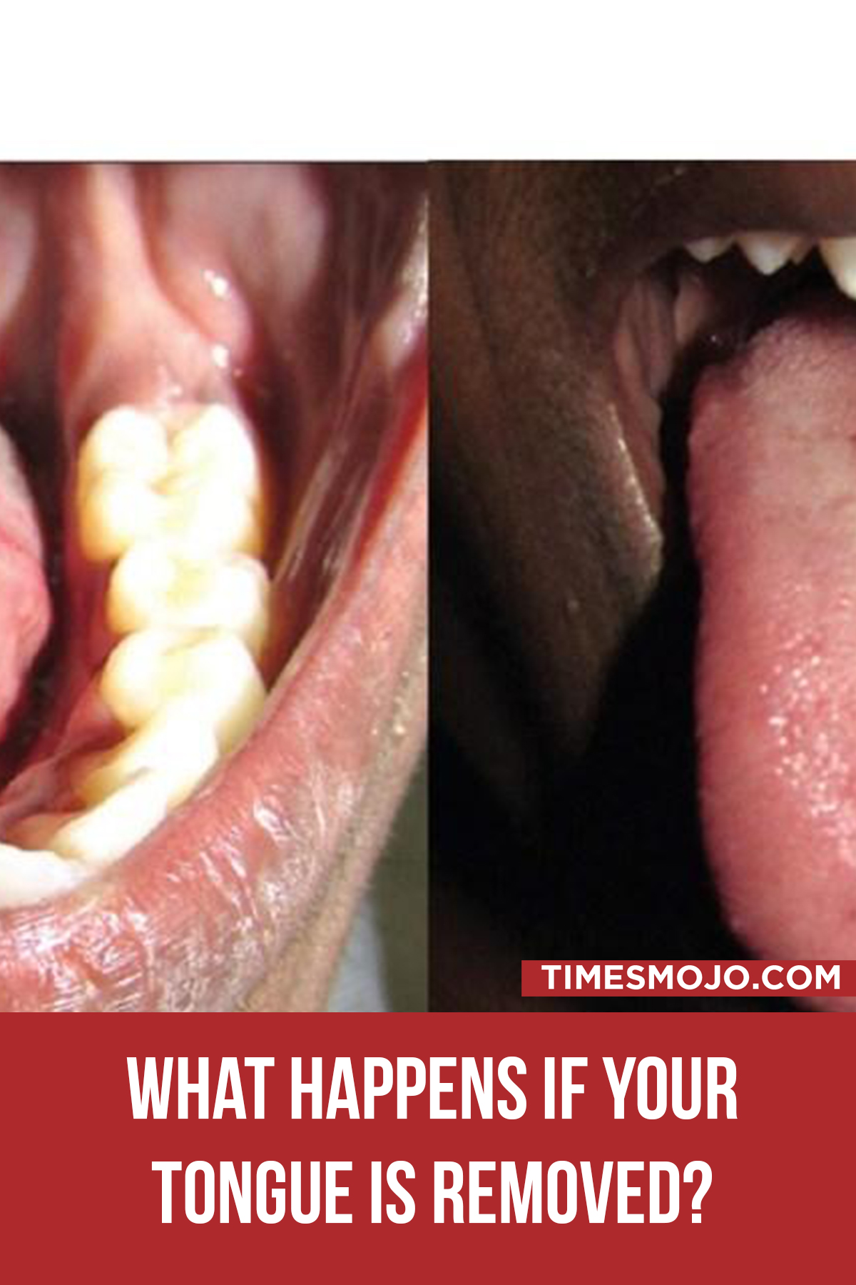 What Happens If Your Tongue Is Removed