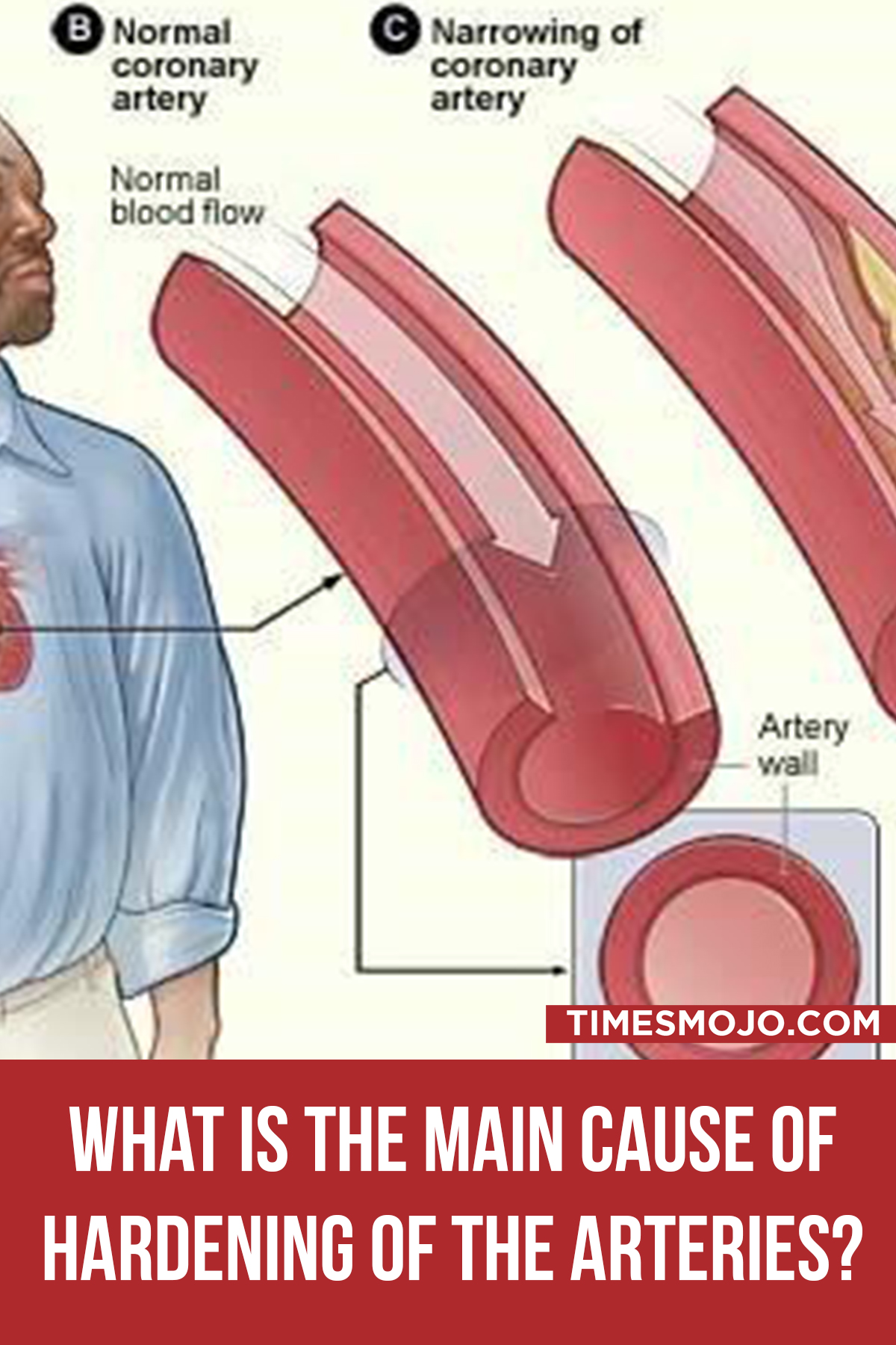 What Is The Main Cause Of Hardening Of The Arteries