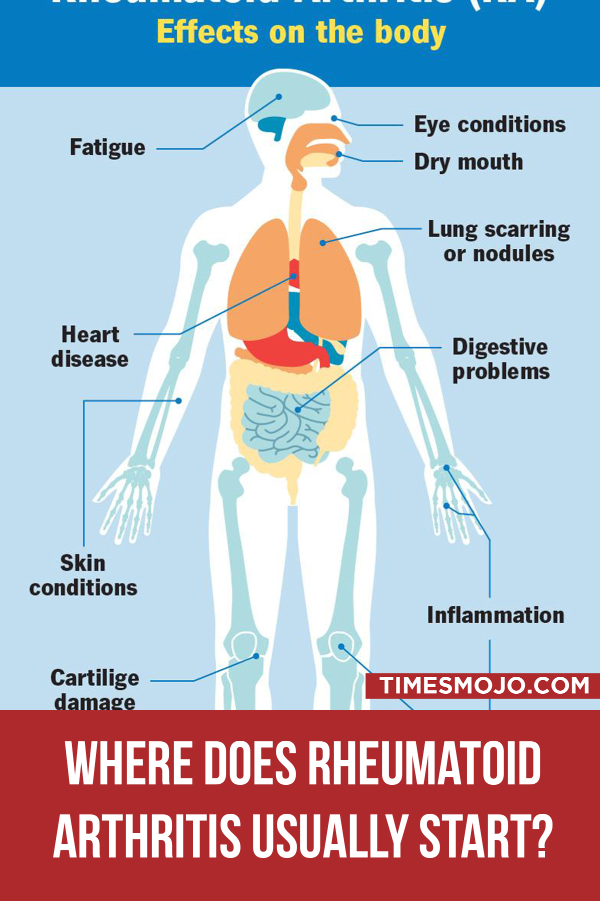 Where Does Rheumatoid Arthritis Usually Start